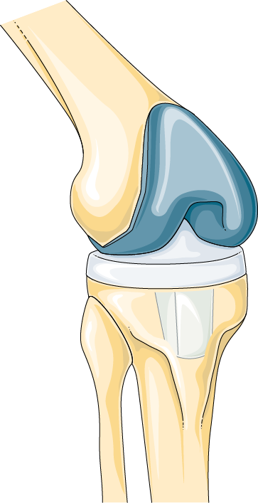 toukhy Knee pain Treatment in Dubai